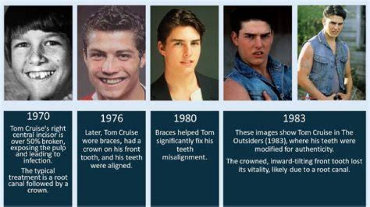 Top 37 Tom Cruise Nose Job Update