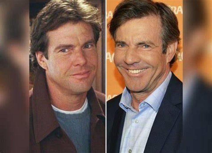 Unmasking The Truth: Dennis Quaid's Journey Through Face Surgery