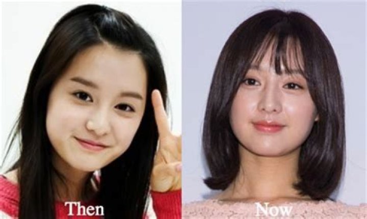 Unveiling The Truth Behind Kim Ji Won's Plastic Surgery: A Comprehensive Analysis