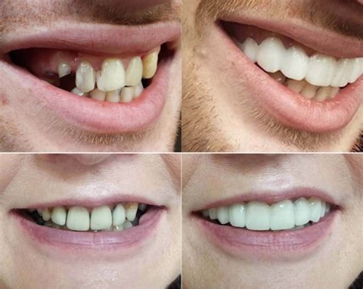 What are clip on veneers? News Dentagama