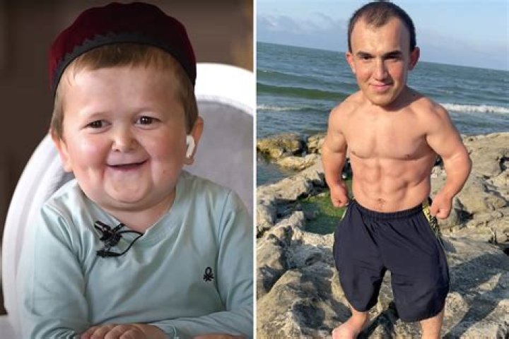 What Is Wrong with Hasbulla? Hasbulla Magomedov Been Diagnosed with A