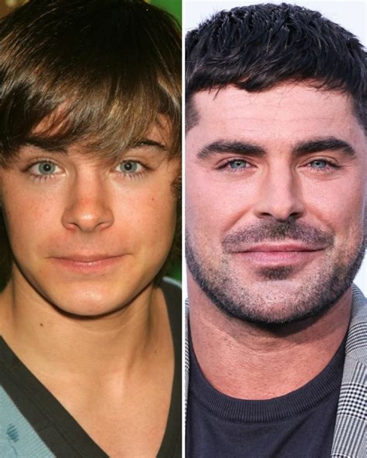 Zac Efron before and after plastic surgery (19) Celebrity plastic