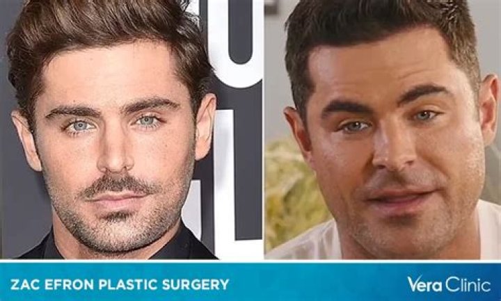 Zac Efron Plastic Surgery Cheap Collection, Save 53 jlcatj.gob.mx